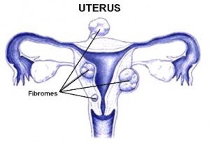 fibromes-uterin